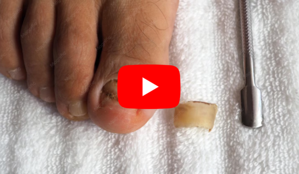DMSO for Toenail Fungus