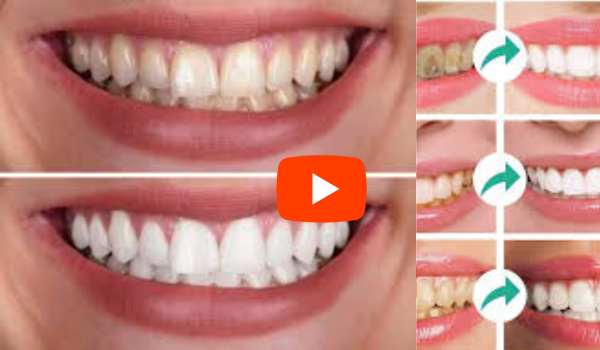 Red Dental Foam For Teeth