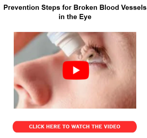 How to Heal a Broken Blood Vessel in the Eye Fast - Prevention