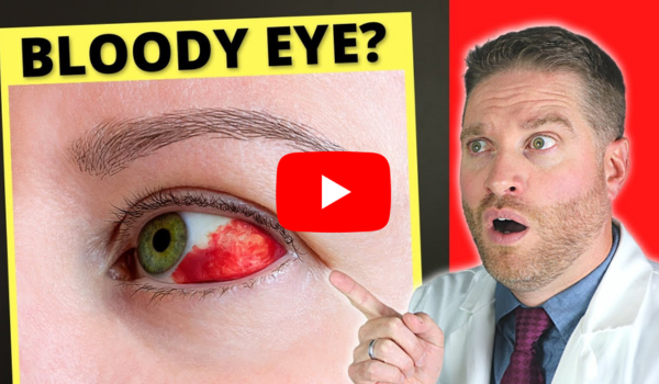 How to Heal a Broken Blood Vessel in the Eye Fast