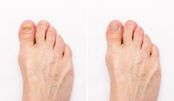 What Kills Toenail Fungus Instantly Image
