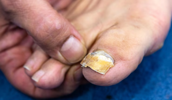 What Kills Toenail Fungus Instantly