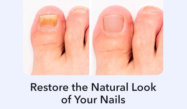 Lunavia Toenail Fungus Pen (2)
