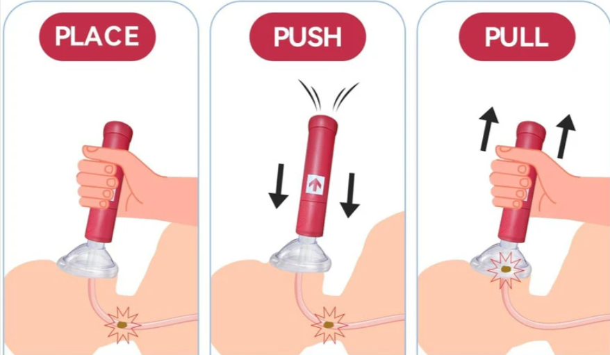 ResQVac Anti-Choke Device Uses