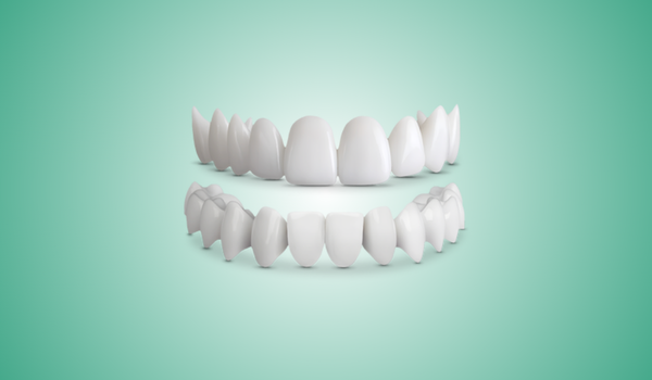 Shiny Smile Veneers Reviews