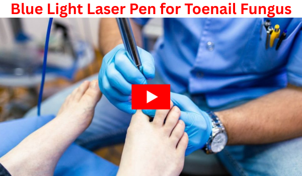 Blue Light Laser Pen for Toenail Fungus
