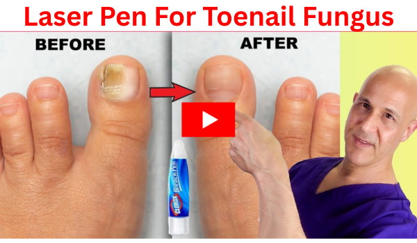 Clorox Pen for Toenail Fungus