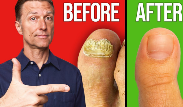 How to get rid of severe toenail fungus