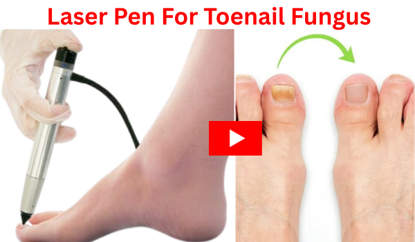 Laser Pen For Toenail Fungus