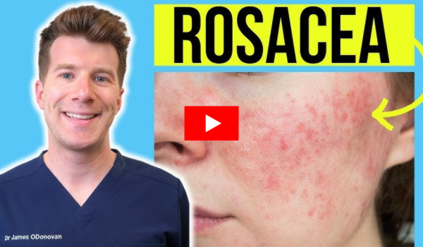 biblical cure for rosacea