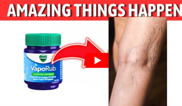 vicks vapor rub for varicose veins