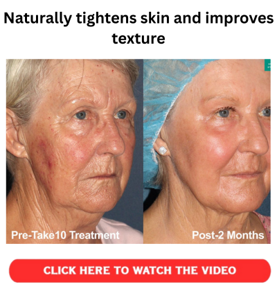 Naturally tightens skin and improves texture