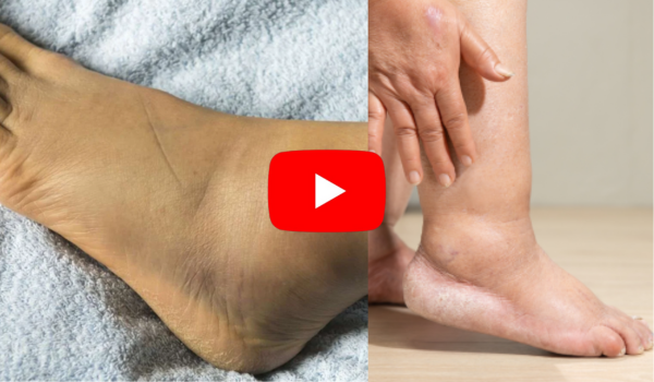 Edema Fluid Drainage and Swelling Ankles