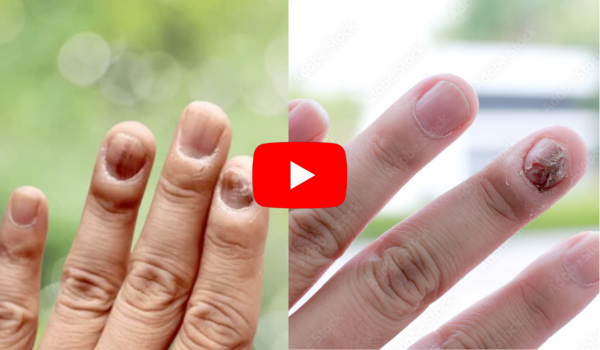 Gingerbread Nails Fungus 