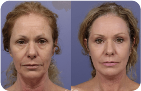 synevra Ultra Lift Befor & After 
