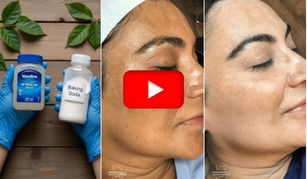 Baking Soda with Vaseline for Dark Spots