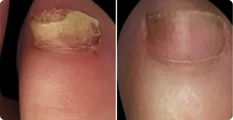 Dermafix Nail Fungus Treatment Gel Customer 1