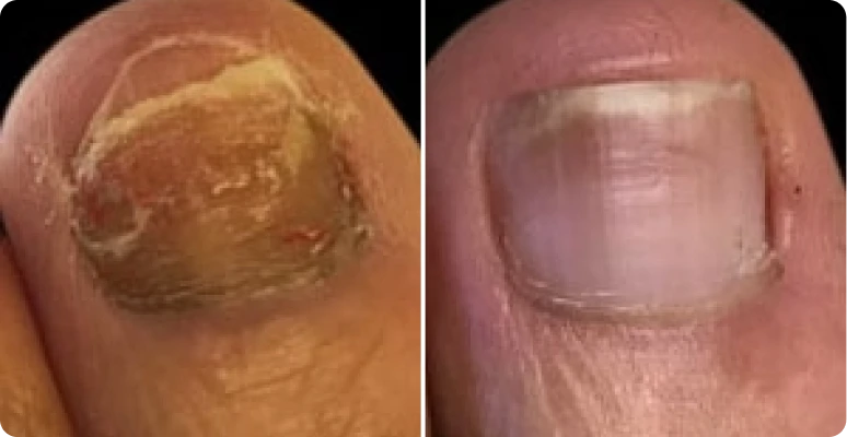 Dermafix Nail Fungus Treatment Gel Customer 3