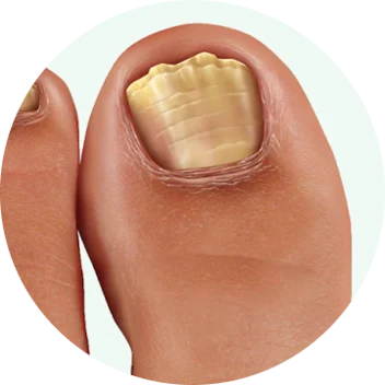Dermafix Nail Fungus Treatment Gel Improvement 1