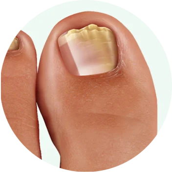 Dermafix Nail Fungus Treatment Gel Improvement 2