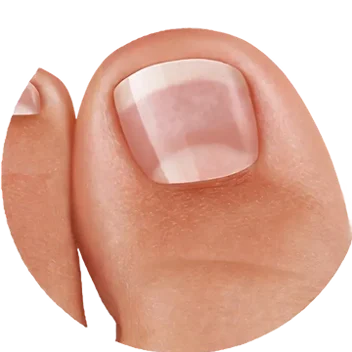 Dermafix Nail Fungus Treatment Gel Improvement 3