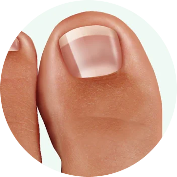 Dermafix Nail Fungus Treatment Gel Improvement 4