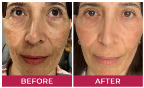 HydraLyft Collagen Face Mask Benefites