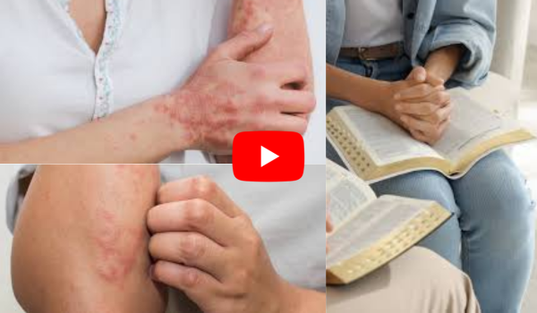 Biblical Cure for Skin Problems