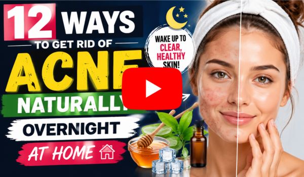 12 Ways to Get Rid of Acne Naturally Overnight at Home