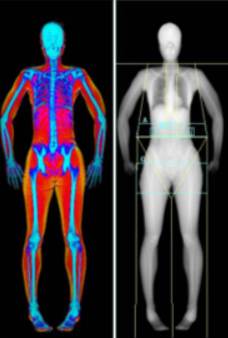 Dexa Scan