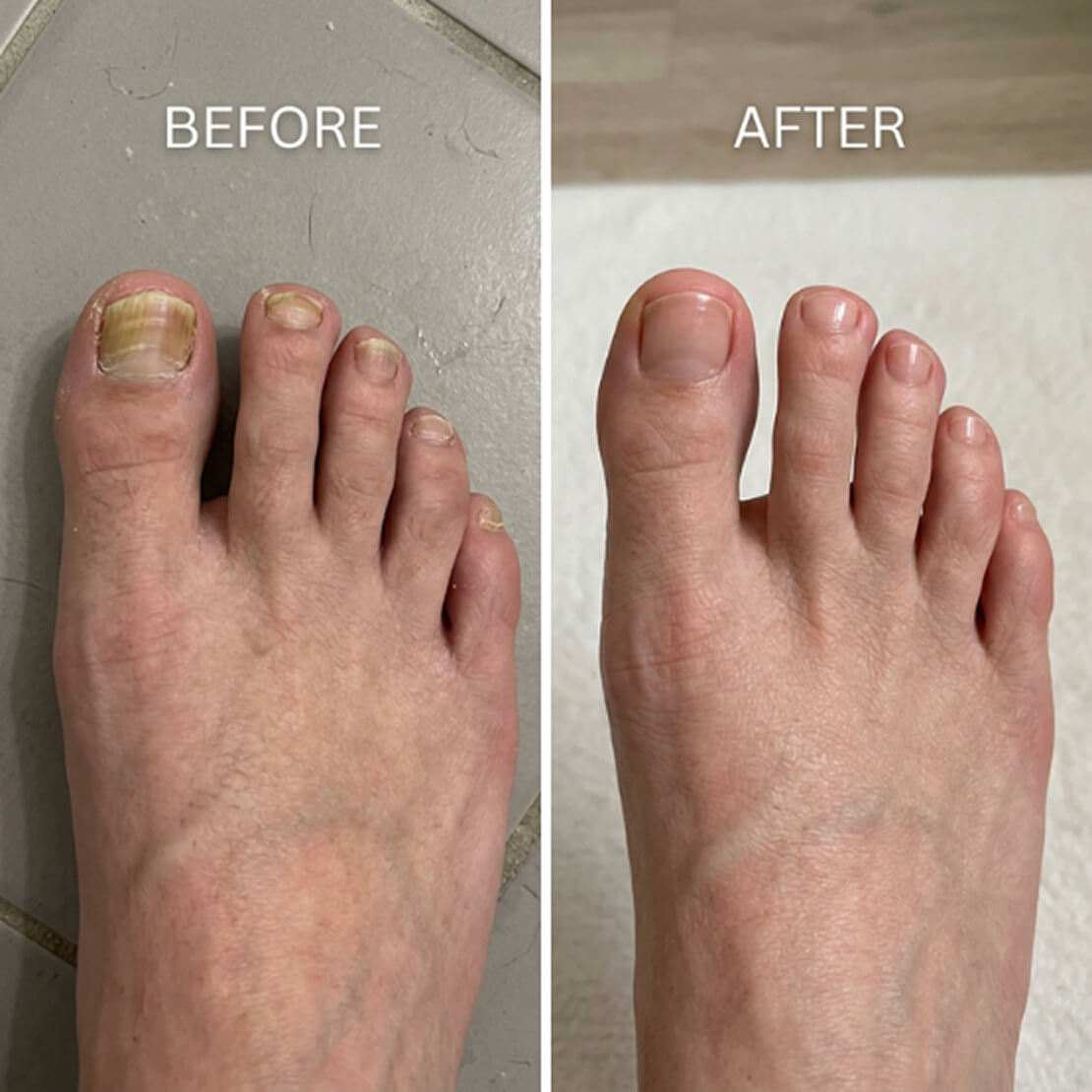 Fungabeam Pen Before After