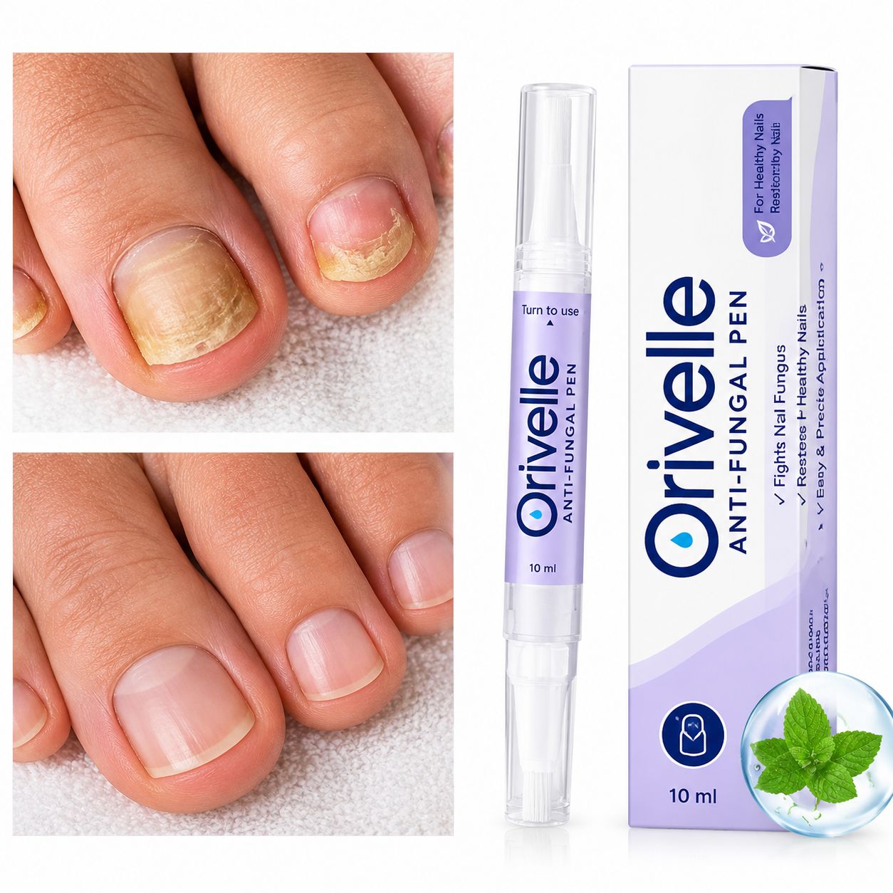Orivelle Antifungal Pen - Best