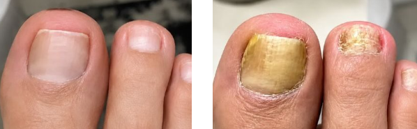 Orivelle Antifungal Pen - before and after