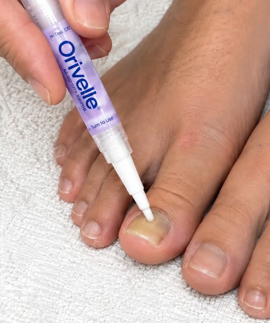 Orivelle Antifungal Pen - use