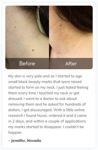 Nuvei Skin Tag Remover Customer Reviews