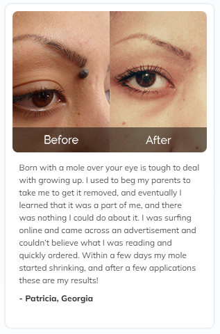 Remedy Skin Tag Remover Before & After Results