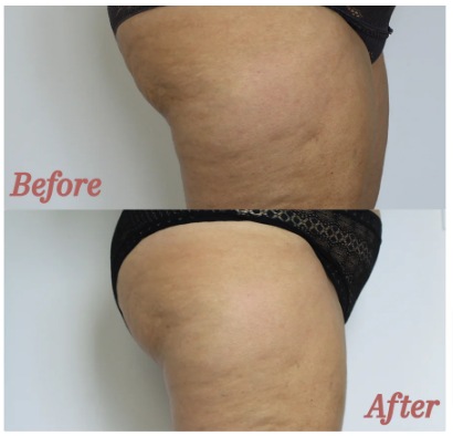 Firm Cellulite Smoothing Cream Before &amp; After Results