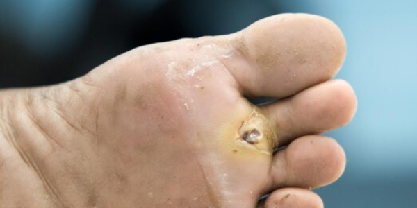 DMSO For Toenail Fungus