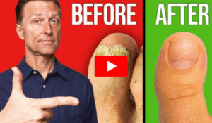 Lunavia Toenail Fungus Pen – Effective & Easy Fungus Treatment